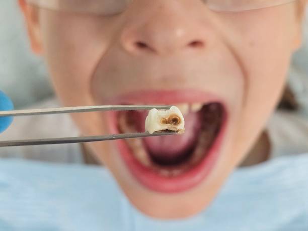 Best Emergency Tooth Extraction in Ansonia, CT